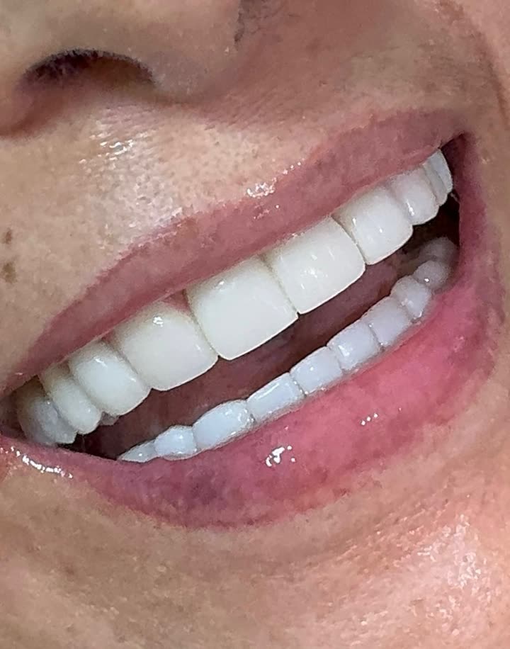 Resultado de rehabilitación oral en Excellent Dental Studio